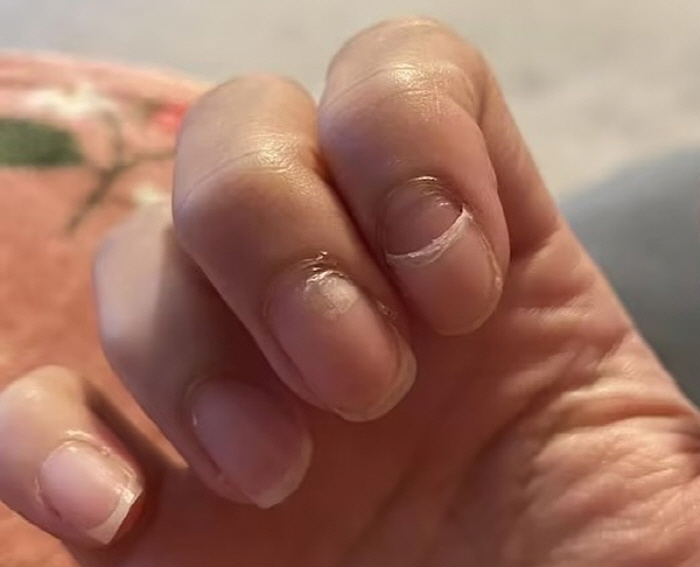 A woman peeling her nails like a snake's skin, because of the aftereffects of the disease