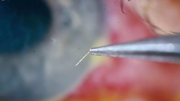 Man with bee sting in the eye, emergency room due to pain and decreased vision