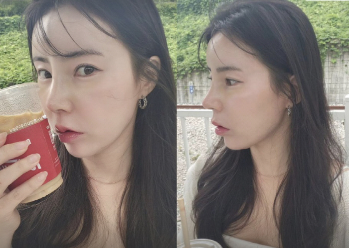 Young-sook, 10th term, nose bridge that has increased significantly after nose plasticization 'Delete the mouth-to-mouth magic'