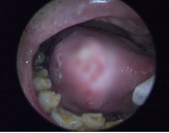 Snow cancer on the tongue, 46% ulcers under 50's, suspicious if it lasts more than 3 weeks