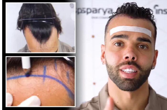 'Who is this?'Hair transplant →Samson