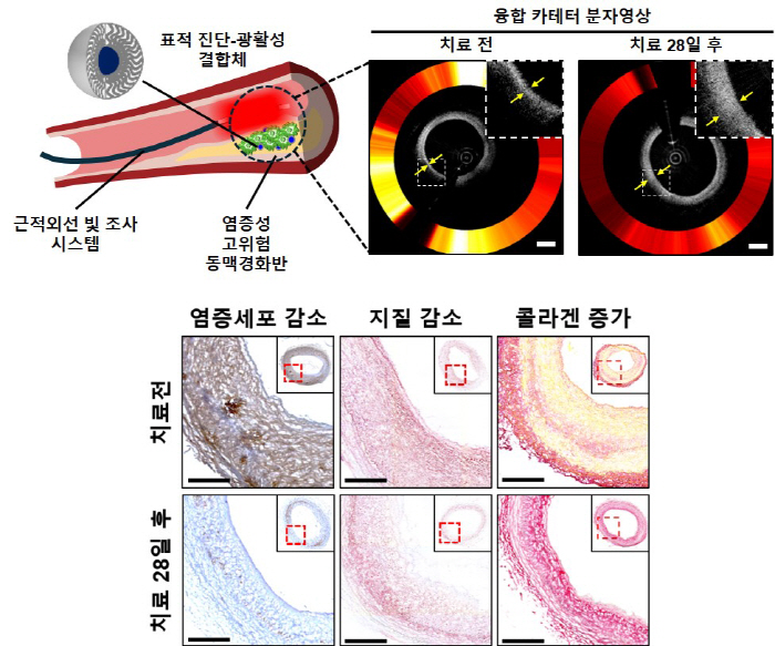 Korea University Guro Hospital Develops Endocardial Vascular Treatment Technology Using Light