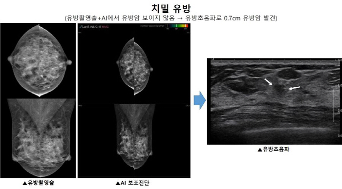 Many Korean Women 'Delicate Breast', Improve Breast Cancer Diagnosis Accuracy with AI and Ultrasound