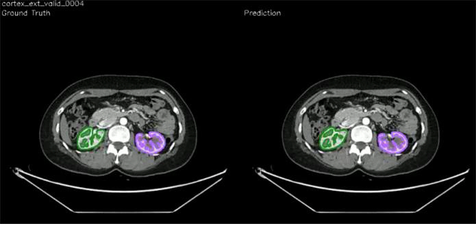 Measurement of renal cortical volume using AI and prediction of renal function loss after donation