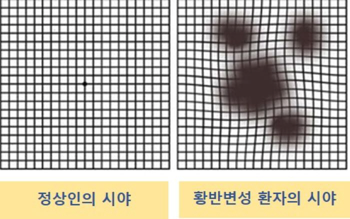 'Does it look like this?' Suspected symptoms of blindness 'yellow degeneration'