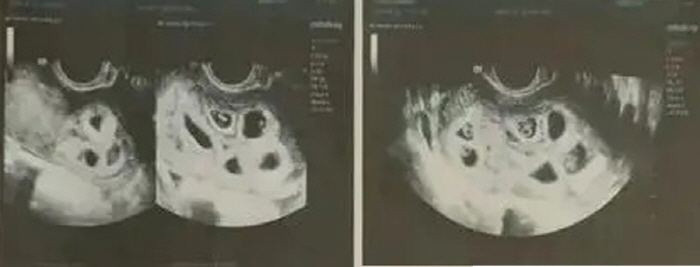 9 fetuses at a time, pregnant'They said it was hard to have a baby'