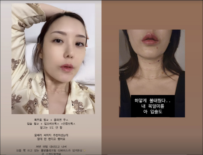 'Dolsing 3' Lee So-ra burned neck wrinkles and lip fillers despite side effects of nose fillers''