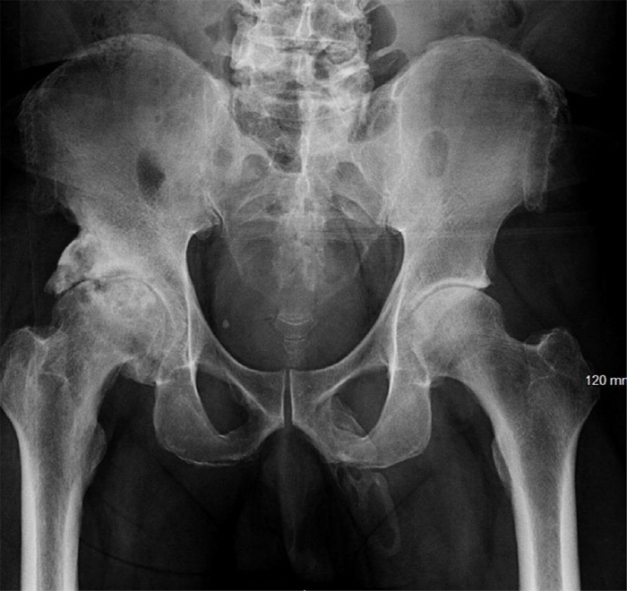Male genitals turned into bones? What kind of disease is it?