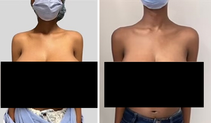 Chest size B cup → Triple G cup gets bigger after COVID-19 vaccination