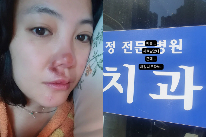 Ko Eun-ah, a mid-sized car with a serious facial injury, and a front tooth in the hospital