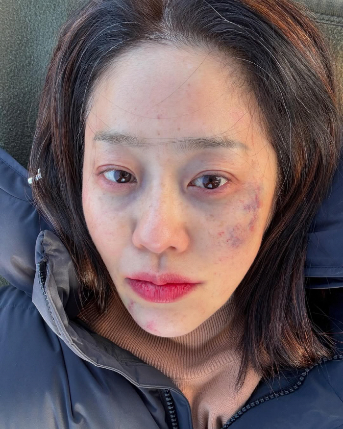 Ko Hyun-jung's bruised face is shocking. What happened on the set