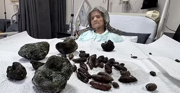 Found 70 black foreign substances in the stomach of an elderly man in his 90s, what did he eat...