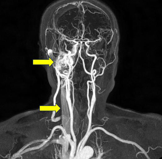 If the heartbeat in the ears persists, there is a possibility of cerebrovascular disease