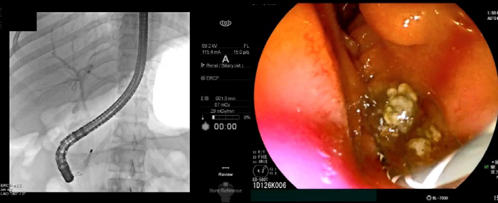 Abdominal pain, fever, suspected bile duct stones when eating greasy food...Too much dieting is also the cause