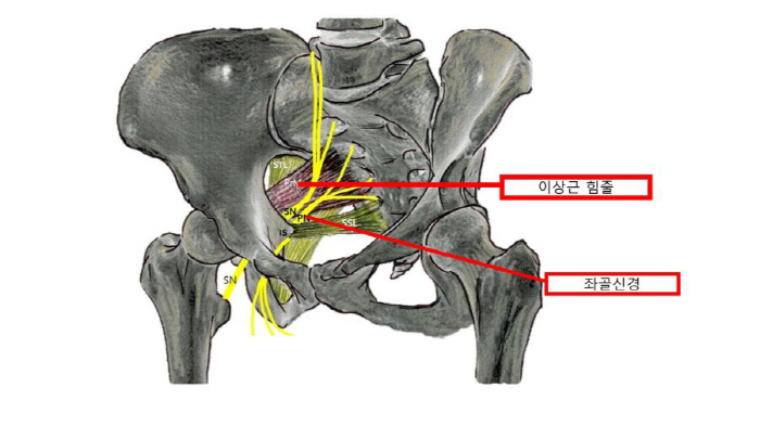 The cause of sciatica and abnormal muscle syndrome, not herniated disc, should also be considered