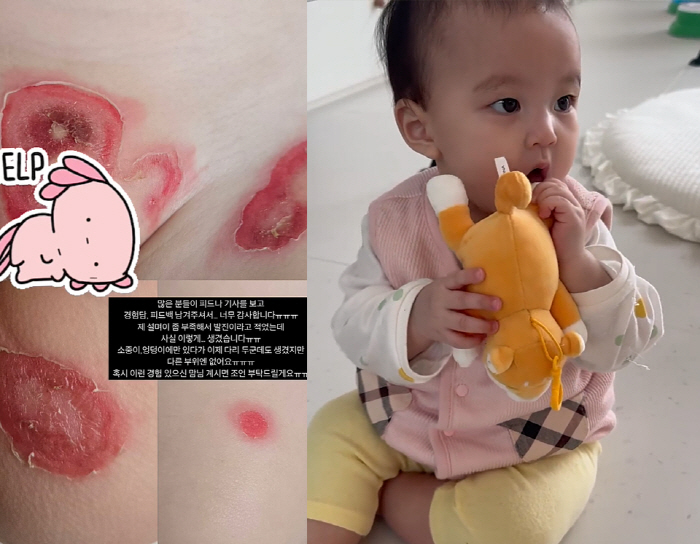 Lee Ji-hoon ♥ Aya's 8-month-old daughter, serious skin rash. I thought it was a rare disease diagnosed by farmers