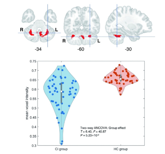 It depends on the hearing recovery of elderly patients, brain health...Artificial Wow Transplantation Predictable