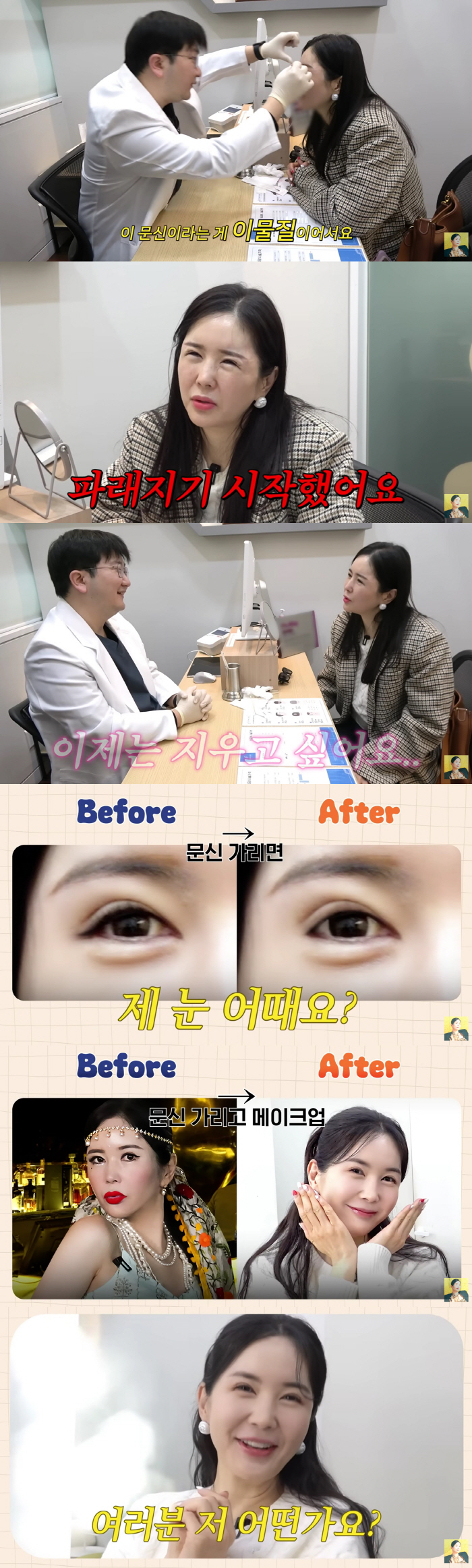 Jang Young-ran, eye surgery No. 4, consulted with plastic surgery again without her husband's knowledge..No-makeup stress like an old lady (Grade A Jang Young-ran) 