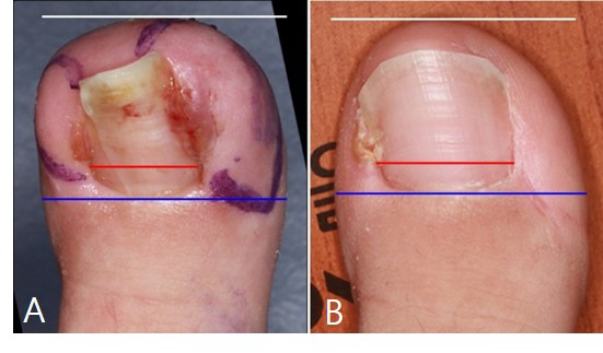 Treating intractable resistant nails, removing the flesh around them, not toenails, is effective