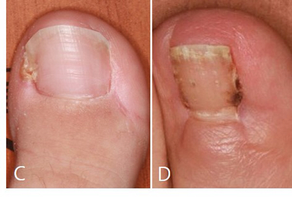 Treating intractable resistant nails, removing the flesh around them, not toenails, is effective