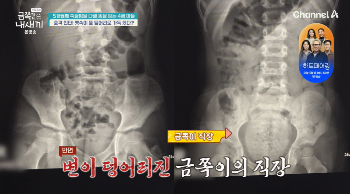 Four-year-old gold is vomiting from exhausting gas after five months of holding her stool, emergency room (my gold baby) 