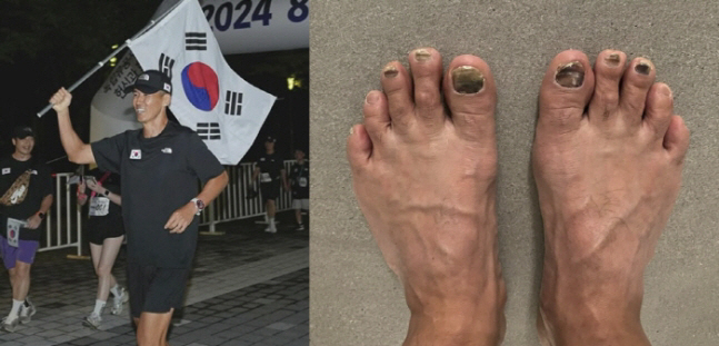 Sean, ♥ Jung Hye-young will be surprised, too. After finishing the marathon, six toenails fell out