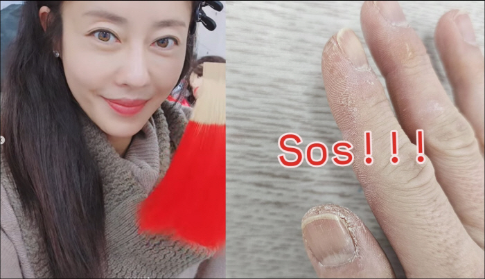 Single Mom Lee Ji-hyun Appeals for Pain in Serious Hand Conditions...It hurts so much even to SOS