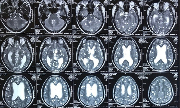 A tapeworm found in a male brain suffering from chronic headaches...I enjoyed eating this