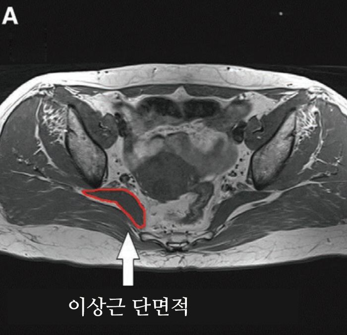 New diagnostic criteria for abnormal muscle syndrome confused with herniated disc