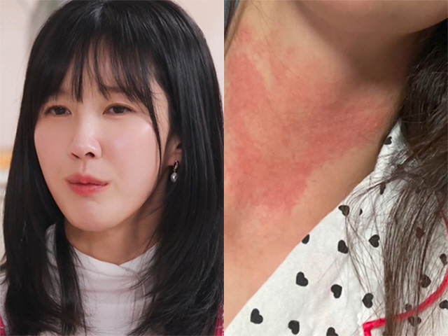 Lee Soo-kyung suspended her activities due to a systemic skin disease. Her face condition is severe..I'm suffering from a social phobia (because I'm solo)