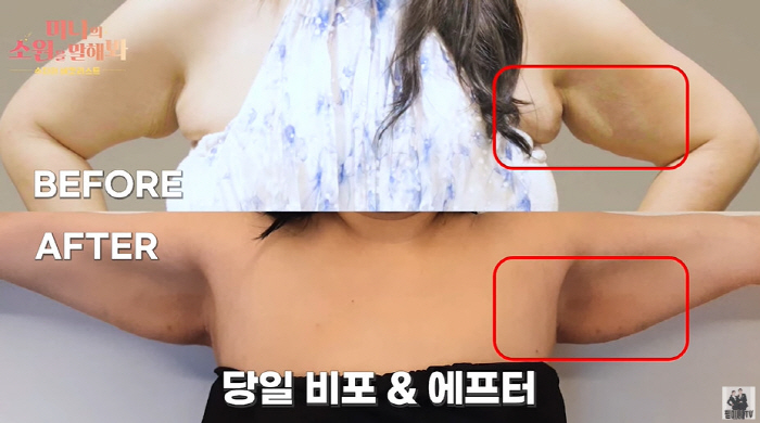 Mina's sister-in-law Suzy lost 60kg  lost forearms  chin fat after the procedure. (Philmi Couple) 