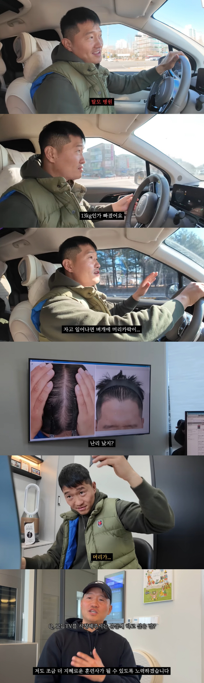 Kang Hyung-wook developed stress-related hair loss after controversy over power abuse I lost 13kg