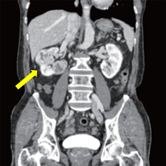  30-50% increased risk of smoking...mostly asymptomatic detection