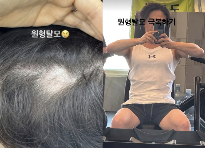 Park Sung-kwang shaved his head against the cancer ♥ Did Lee Sol have a hard time..Overcoming the hardship of hair loss