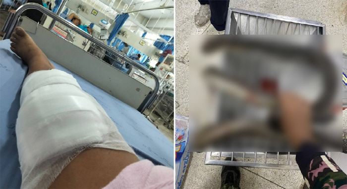 When she was bitten by a venomous snake, the woman caught her with her bare hands and took her to the hospital, there was a reason
