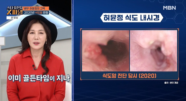 24cm resection due to esophageal cancer..I was scared by the 15kg drop
