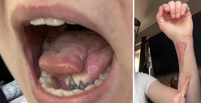 A woman in her 20s who had her tongue partially resected due to oral cancer, you can't ignore this in her mouth