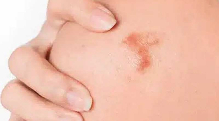 Identify the mechanism of skin disease keloid...Expecting a New Treatment Strategy