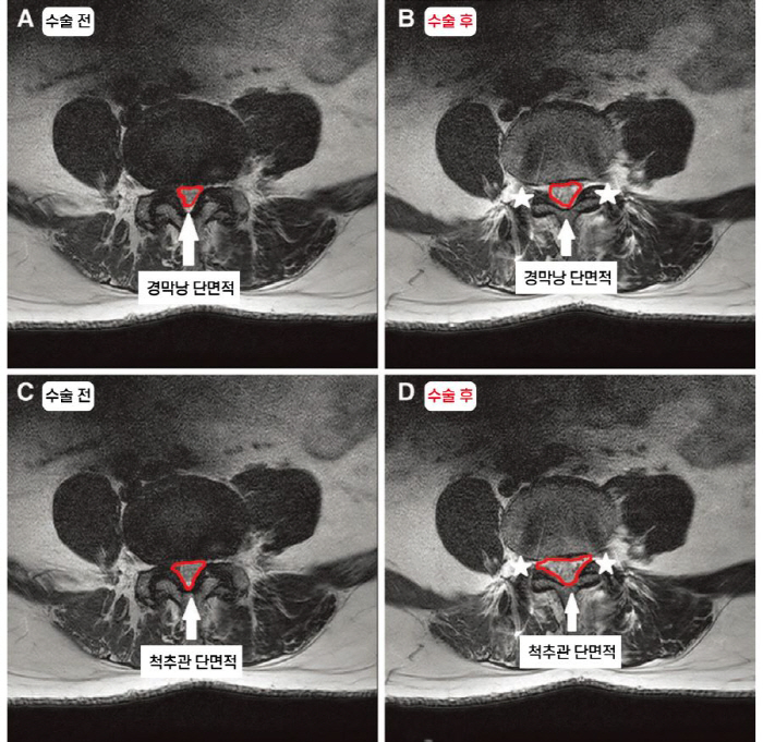 Successful Analysis of Vertebral Morphological Changes After Surgery for Spondylolisthesis
