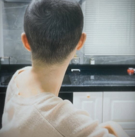 Cancer-fighting Lee Sol loses her eyebrows after chemotherapy and her hands turn black