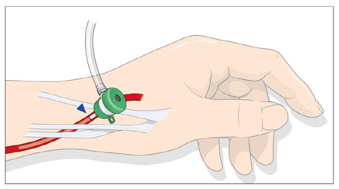Demonstrate safety of minimally cardiovascular incision by patient gender