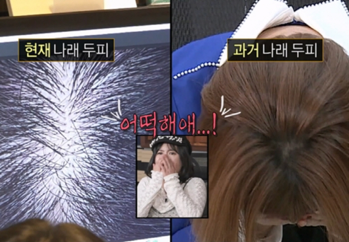 Park Na-rae confesses to hair loss, shocking top of the head..Causes of aging  male hormones (Bahmoxane)
