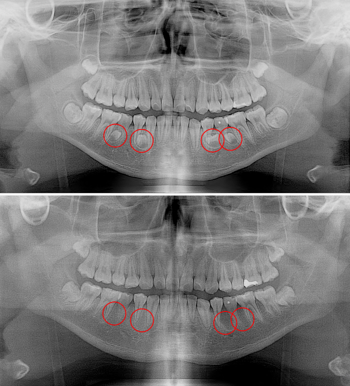 Excessive teeth with more teeth, time bomb in mouth if not treated in time