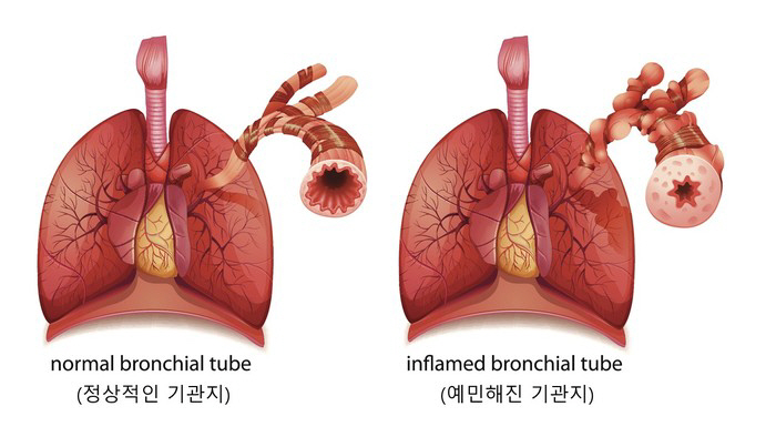  Life threatening when having an acute asthma attack...How does your height grow when you take medicine?