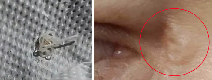 Pain and itching around the eyes, it turns out that dog and cat parasites wriggle