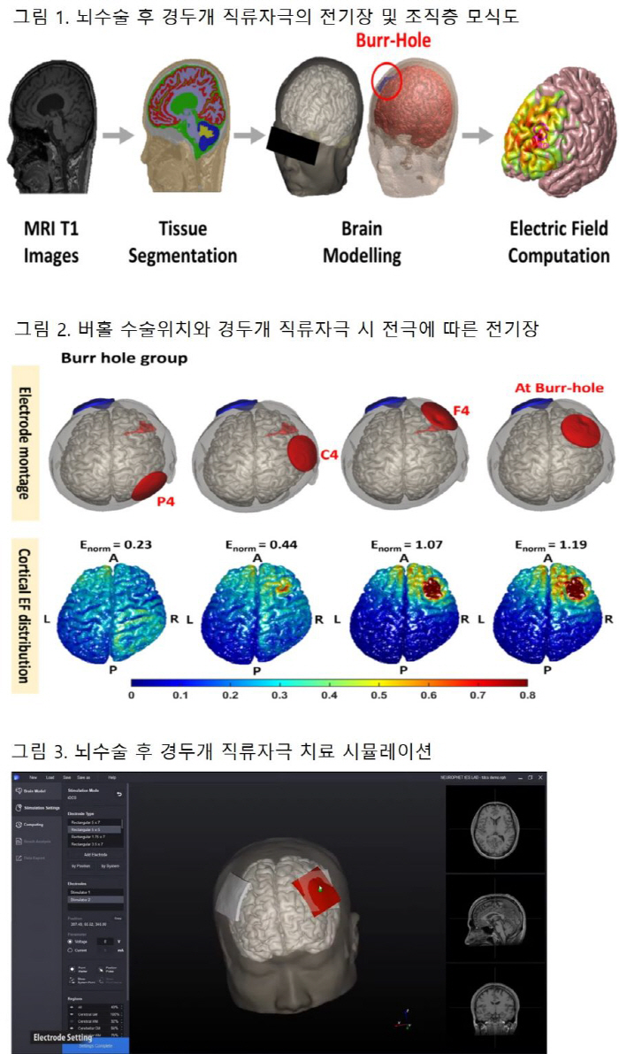 Electronic drug direct current stimulation of the transcranial head, and patients with skull damage can also be treated