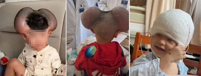 3 year old called Mickey Mouse because of a head bump, what disease is it?