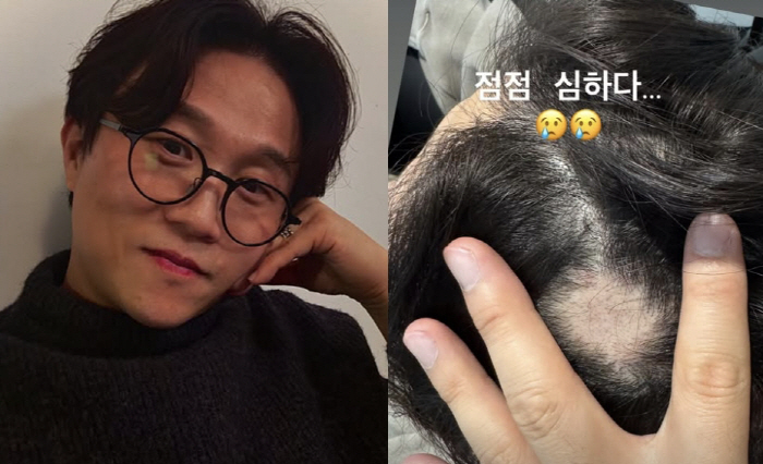 Isol ♥ Park Sung-kwang, the phenomenon of circular hair loss getting bigger and bigger is serious
