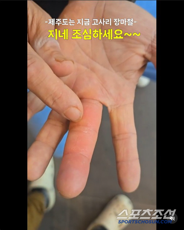 Kim Byung-man's swollen hands  clear teeth marks after being withdrawn by giant centipedes