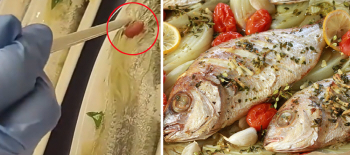 A man who swallowed a 5cm long fishbone died, and what caused his death?